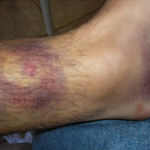 bruising